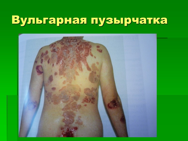 Вульгарная пузырчатка